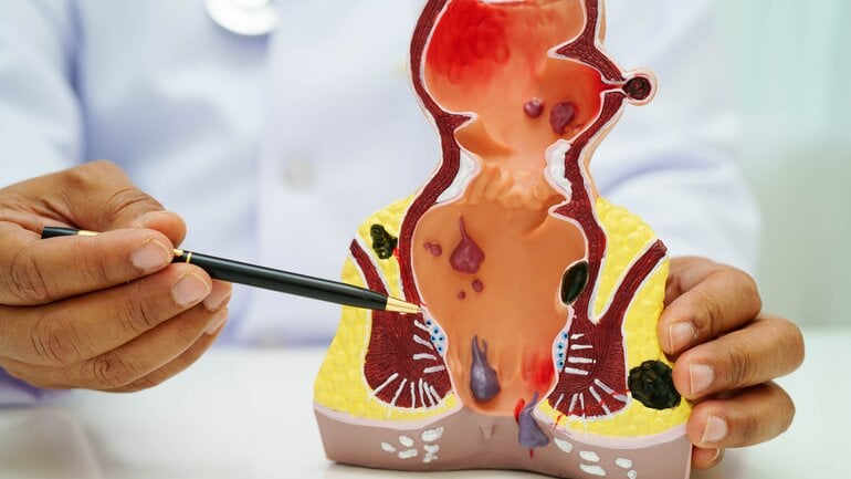 Blut im Stuhl durch Hämorrhoiden