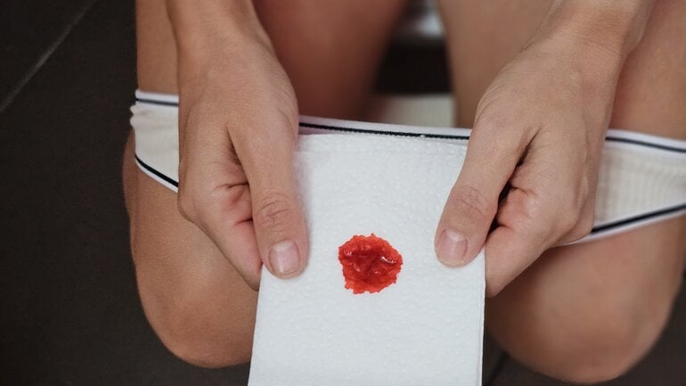 Gefäßmissbildungen können Blut im Stuhl verursachen