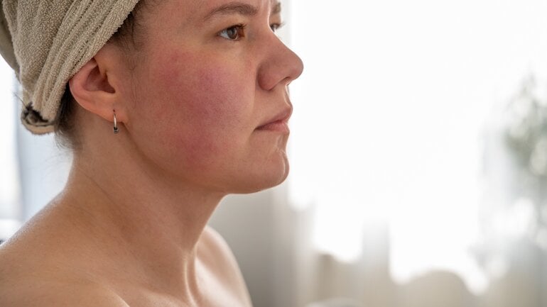 Hypertonie: Rotes Gesicht und Hitzewallungen sind Symptome