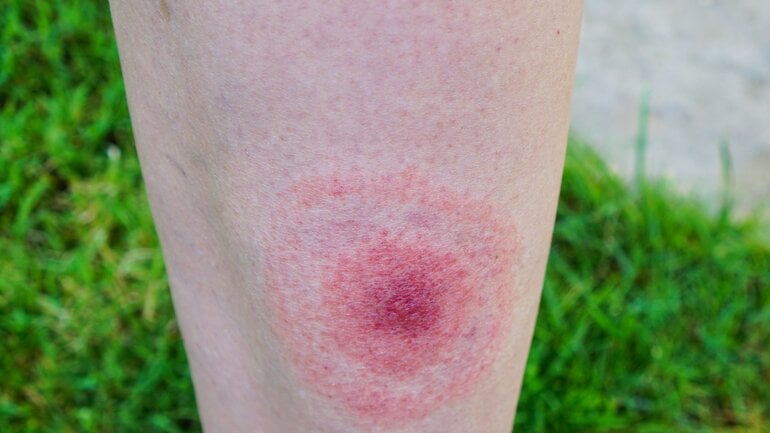 Wanderröte ist oft der deutlichste Hinweis auf Borreliose
