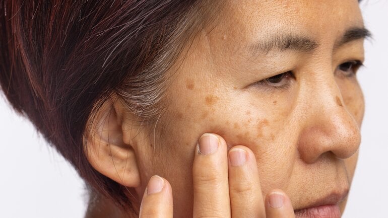 Braune Flecken im Gesicht: Melasma