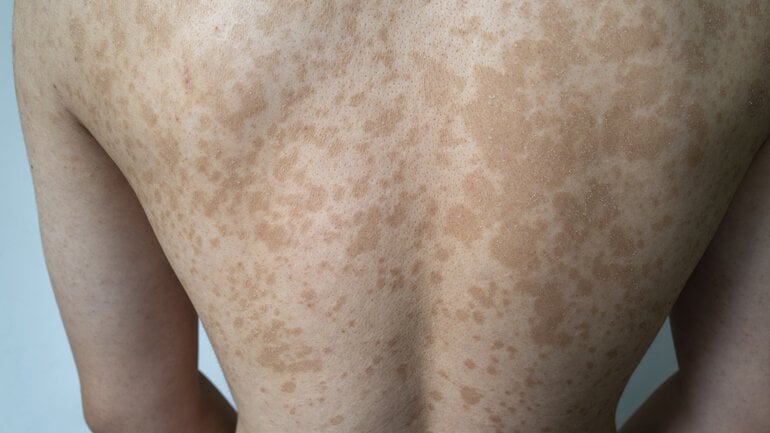 Kleienpilzflechte: Braune Flecken durch einen Hautpilz