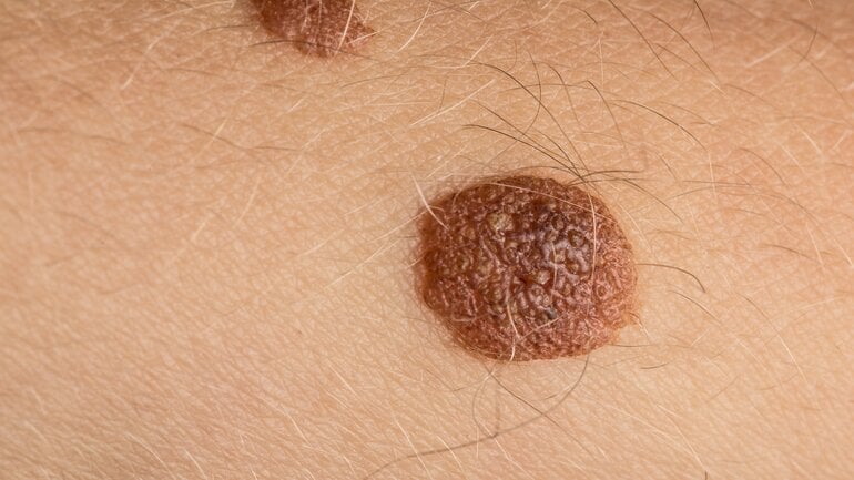 Dunkle Flecken auf der Haut: Seborrhoische Keratose