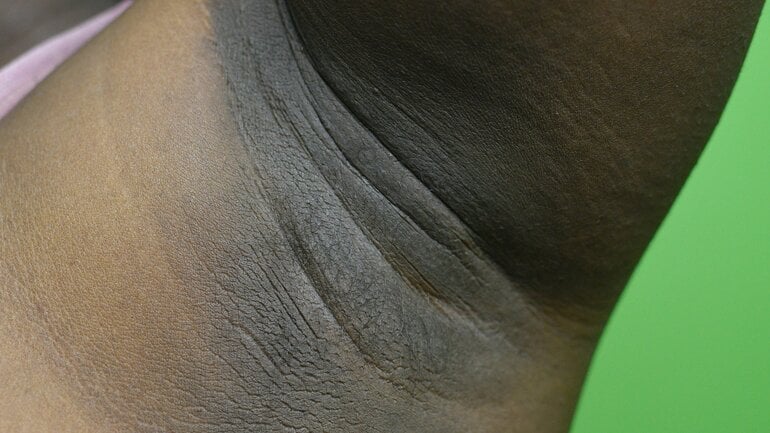Acanthosis nigricans ist Ursache für dunkle Hautflecken