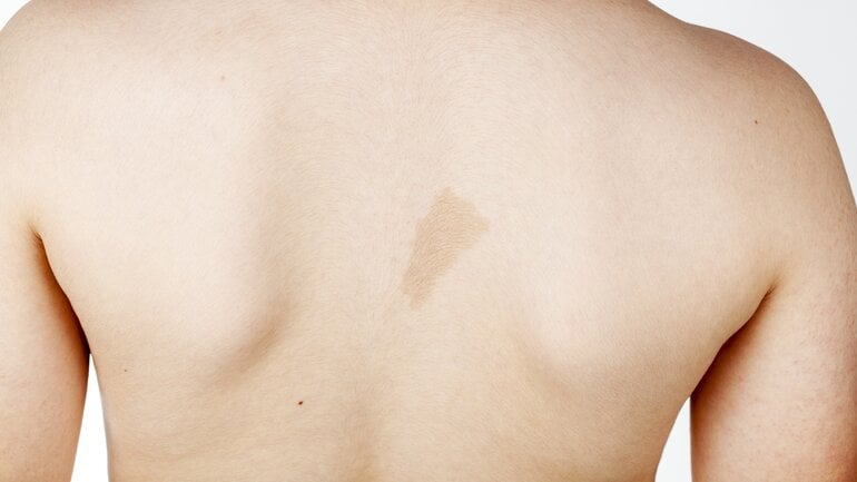 Dunkle Flecken auf der Haut: Café-au-lait-Flecken