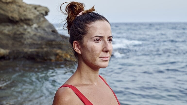 Braune Flecken auf der Haut durch eine Autoimmunerkrankung