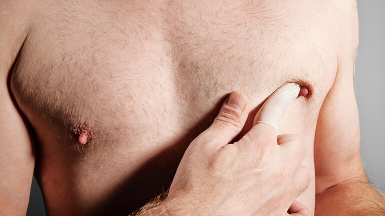 Brustkrebs beim Mann: Flüssigkeit aus der Brustwarze