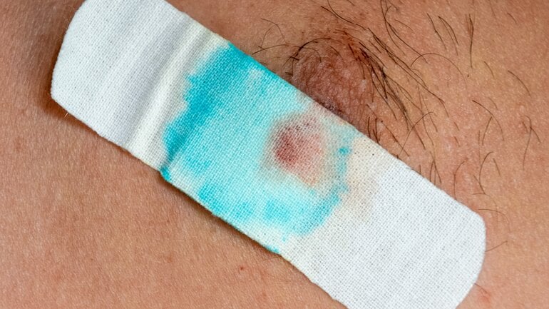 Brustkrebs beim Mann: Wunde an der Brustwarze