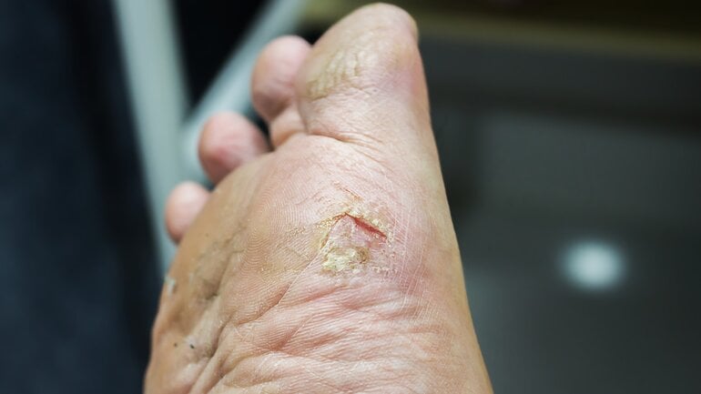 Diabetisches Fußsyndrom als Komplikation