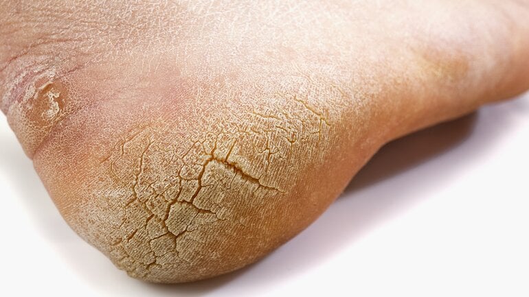 Diabetischer Fuß: Hornhaut und Risse als Warnsignal
