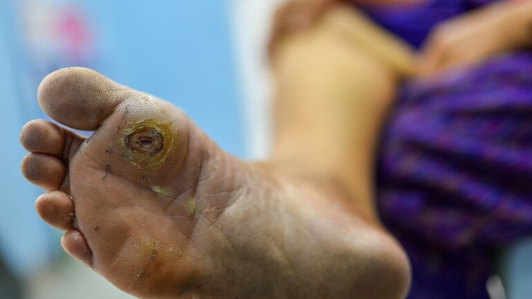 Diabetiker Fuß: Bild zeigt Geschwür an der Fußsohle