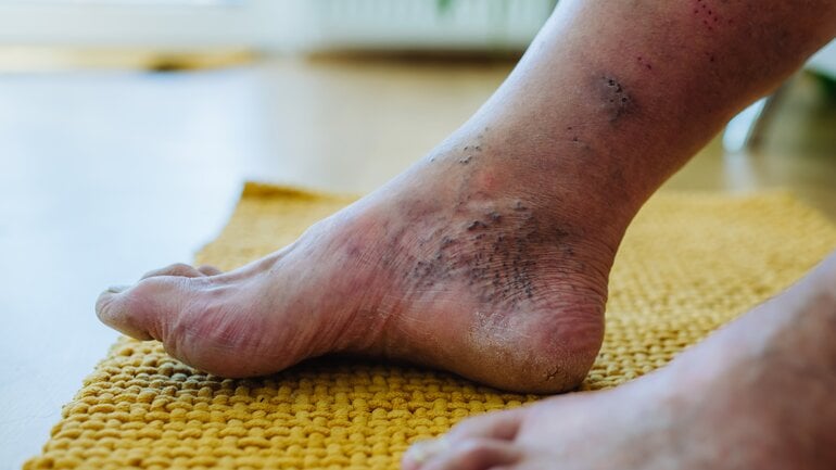 Charcot-Fuß: Knochen- und Gelenkveränderungen