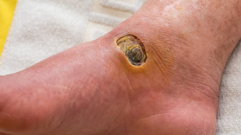 Diabetischer Fuß: Schwarze Stellen durch Nekrosen