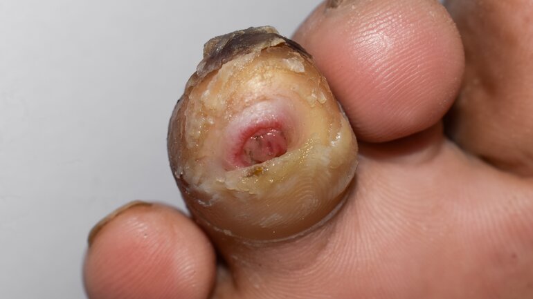Diabetisches Fußsyndrom: Bild zeigt schweres Stadium