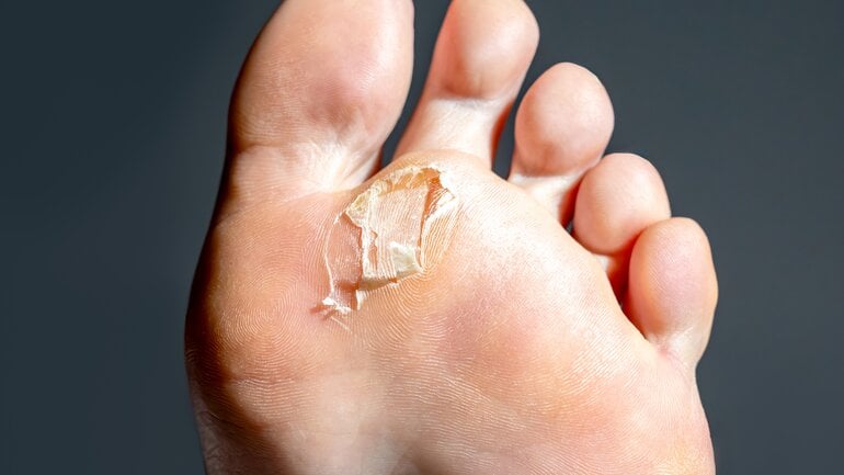 Diabetischer Fuß: Blasen und Druckstellen im Frühstadium