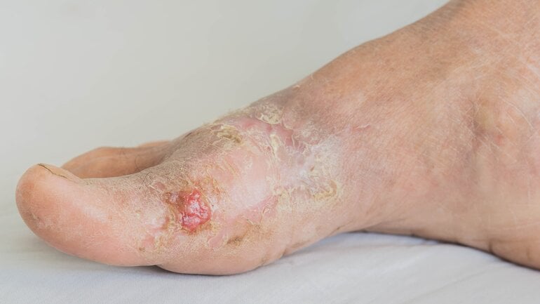 Foto zeigt diabetischen Fuß
