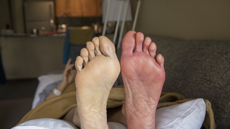 Bild von Durchblutungsstörungen an den Füßen und Beinen