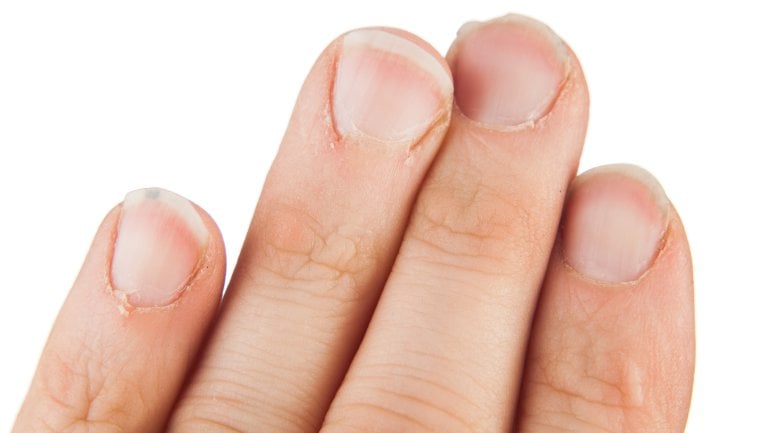 Eisenmangel zeigt sich durch Symptome an Nägeln
