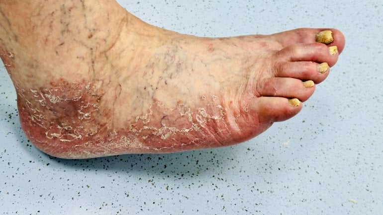 Bild von Fußpilz im Spätstadium