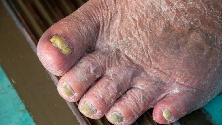 Fußpilz und Nagelpilz: Bild zeigt schweren Verlauf