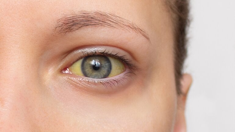 Gallengangskarzinom: Gelbsucht ist typisches Symptom