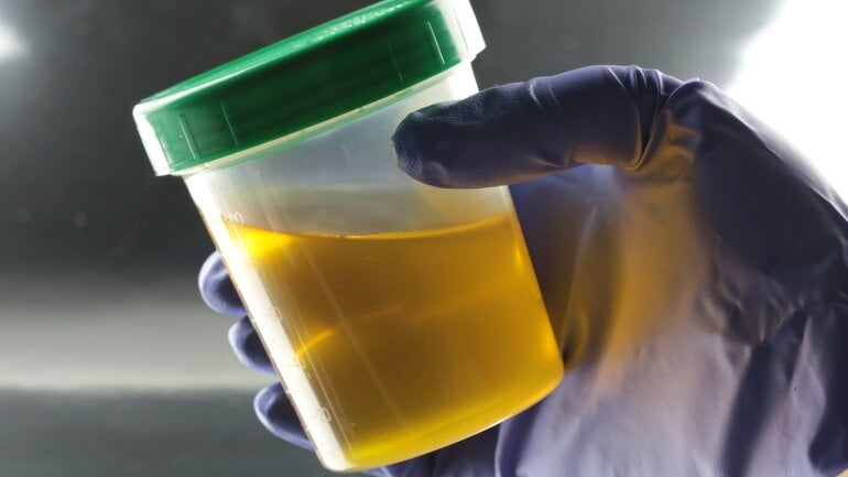 Dunkler Urin kann auf Gelbsucht hinweisen