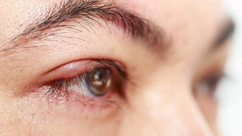 Schwellung am Auge? Symptom bei Gerstenkorn
