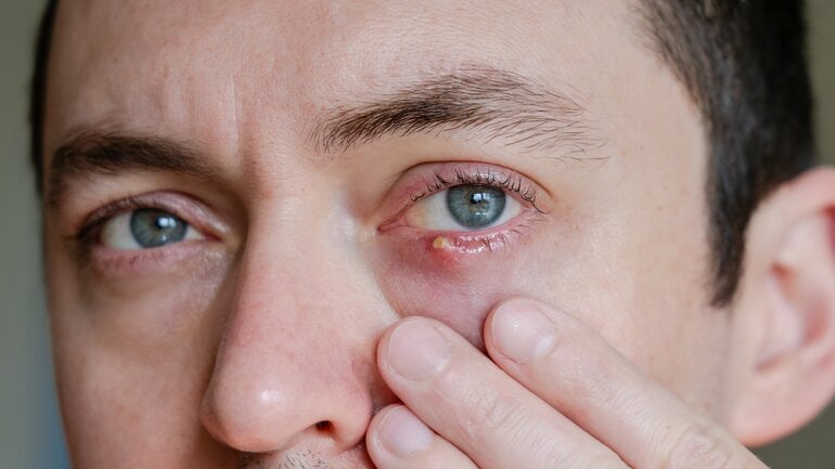 Sichtbarer Eiterpunkt: Symptom eines Gerstenkorns