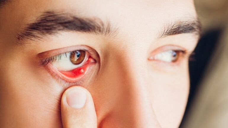 Inneres Gerstenkorn: Bild der seltenen Form