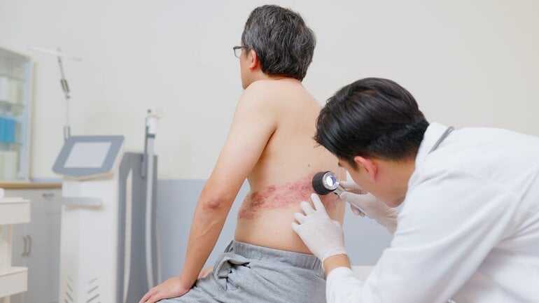 Gürtelrose kann bei Immunschwäche gefährlich werden