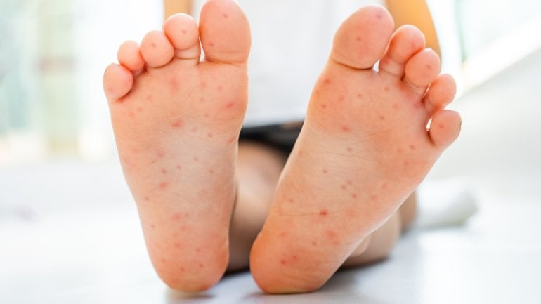 Bilder der Hand-Fuß-Mund-Krankheit: Ausschlag an den Füßen