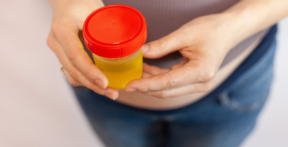 Frau hält Urinbehälter in der Hand, da sie Blut im Urin hat, ein mögliches Symptom bei Harnröhrenkrebs.