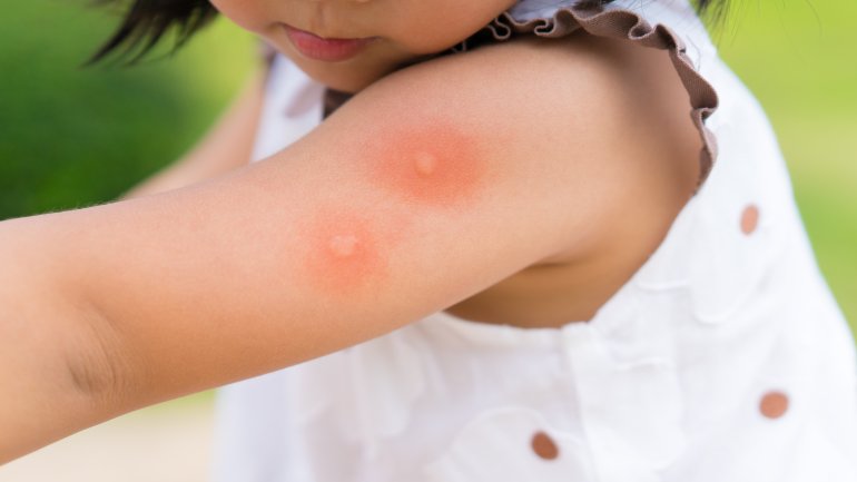 Mückenstiche bei Kindern erkennen