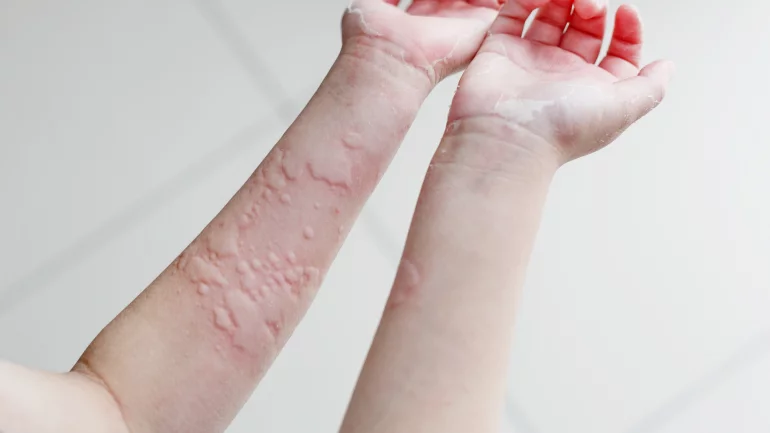 Hauttausschlag erkennen: Nesselsucht bei Kindern