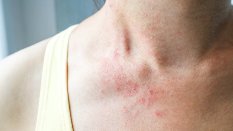 Hautkrankheiten erkennen: Bild von Dermatomyositis