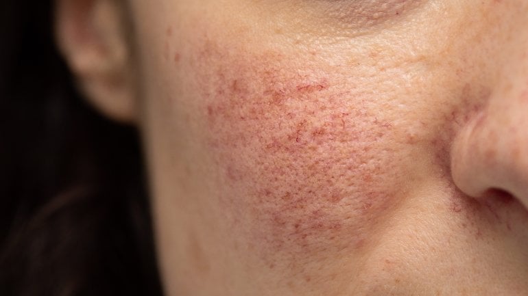 Hautkrankheiten erkennen: Bild von einer Couperose