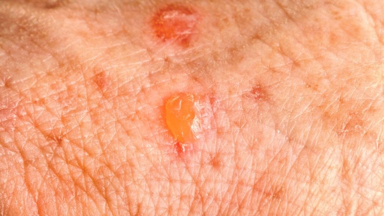 Hautkrankheiten: Bild von aktinischer Keratose