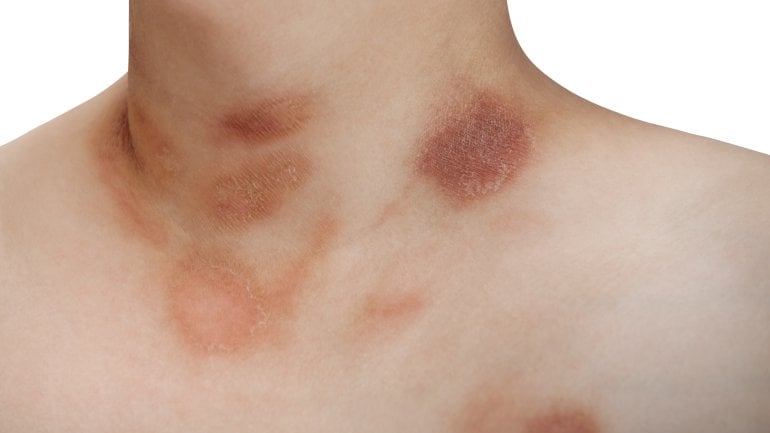 Bild einer Röschenflechte: Hautkrankheiten erkennen