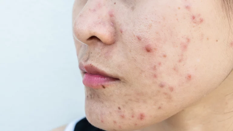 Hautkrankheit erkennen: Akne