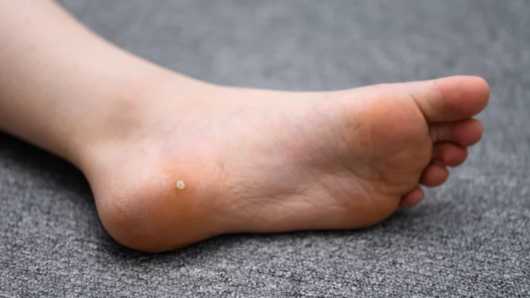 Warzen am Fuß: Häufige Hautkrankheit erkennen