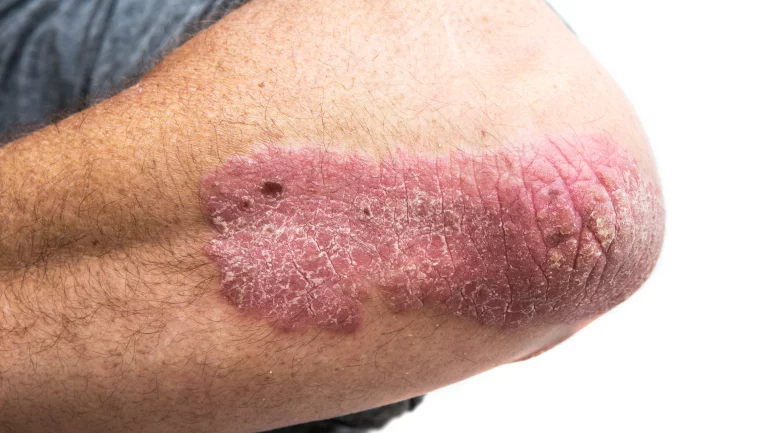 Hautkrankheit erkennen: Bild einer Schuppenflechte