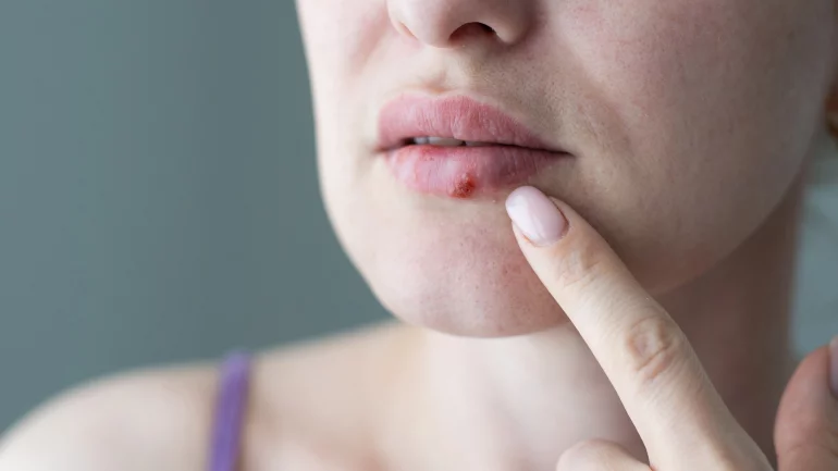 Hautkrankheiten: Lippenherpes erkennen