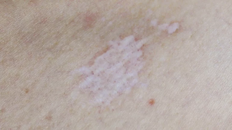 Hautkrankheiten erkennen: Bild von Lichen sclerosus
