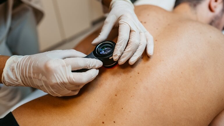 Hautkrebs: Dermatoskopie hilft bei Diagnose