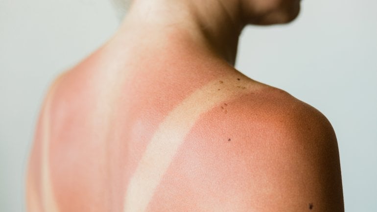 Hautkrebsrisiko Sonnenbrand