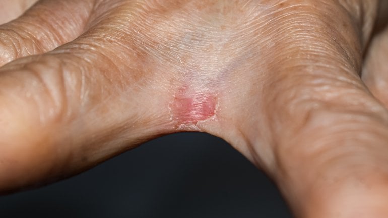 Bild von Hautpilz an der Hand: Trockene, rissige Haut mit Schuppung