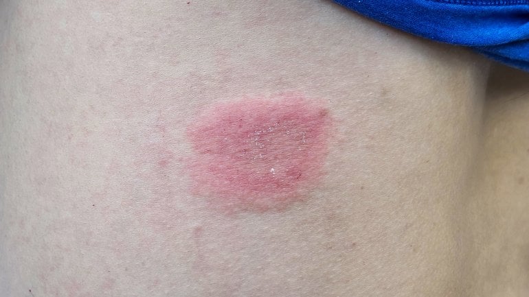 Bilder von Hauptpilz am Körper: Ringförmige Rötungen