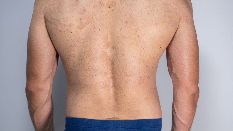 Hautpilz mit weißen oder dunklen Flecken: Kleienpilzflechte am Rücken