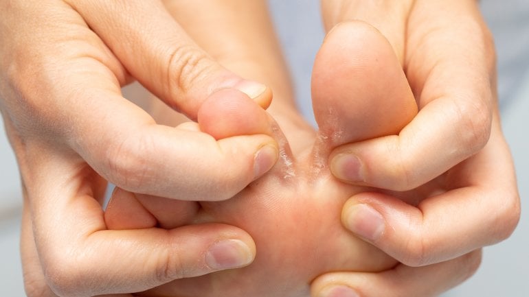 Hautpilz am Fuß: Rote, juckende, schuppende Haut