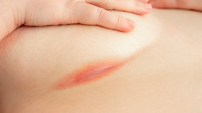 Hefepilz auf der Haut: Nässende Hautfalten mit weißlichem Belag